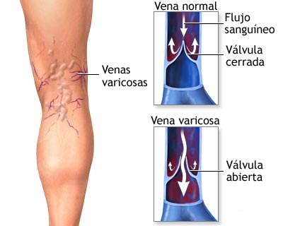 varices01