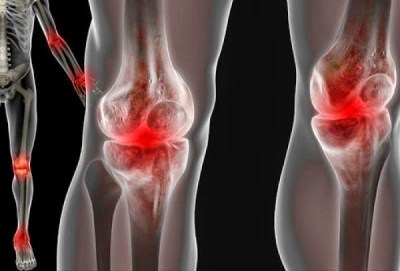 El mejor remedio casero contra la inflamación de las articulaciones El mejor remedio casero contra la inflamación de las articulaciones