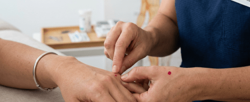 Practitioner marking acupuncture points on patient's hand with red dots